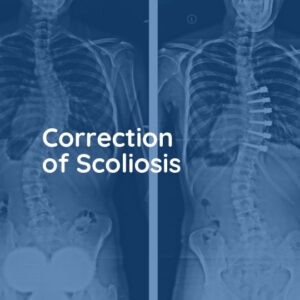 Correction of Scoliosis